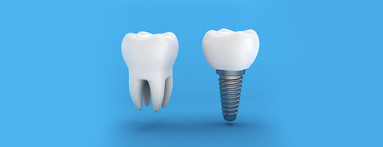 Why Do You Need Dental Implants?