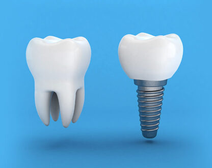 Why Do You Need Dental Implants?