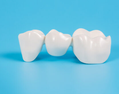 Is It Challenging to Eat with a Dental Bridge?
