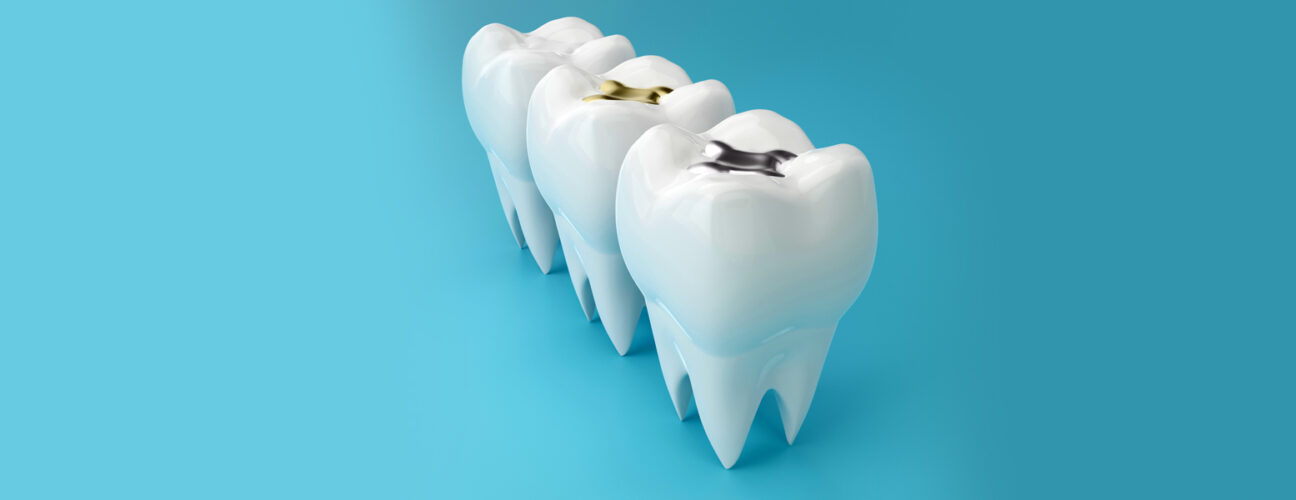 Why Do Fillings Need to Be Replaced