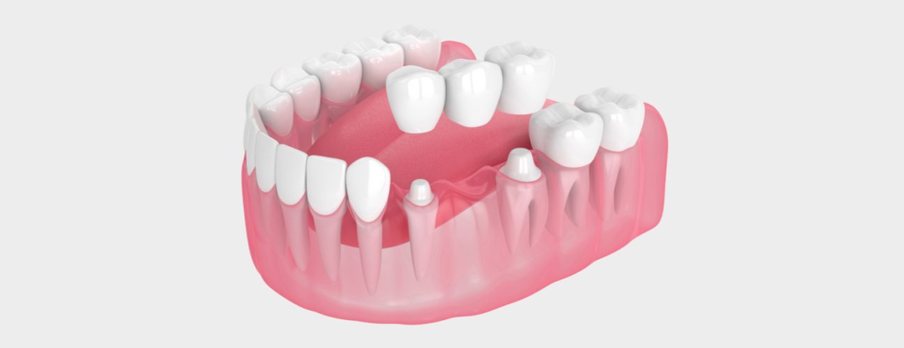 Dental Bridges