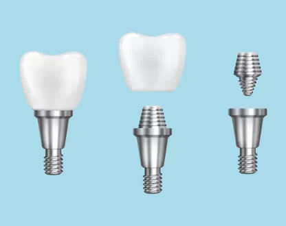 Can You Get a Dental Implant for Two Missing Teeth?